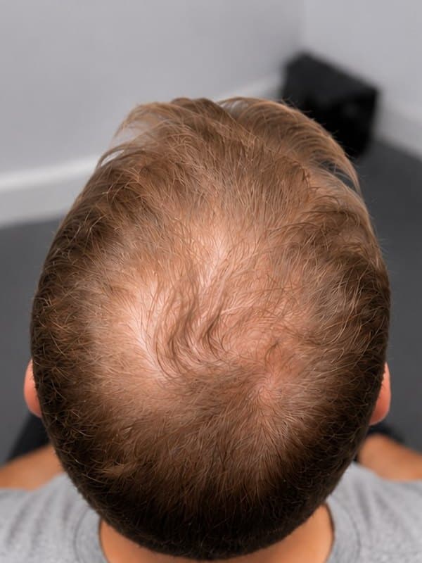 Tricopigmentation, couronne dégarnie, homme, Avant