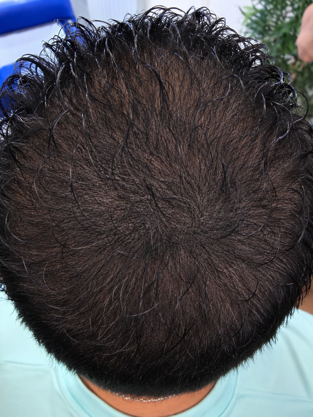 Tricopigmentation, complément de greffe, vertex, Après