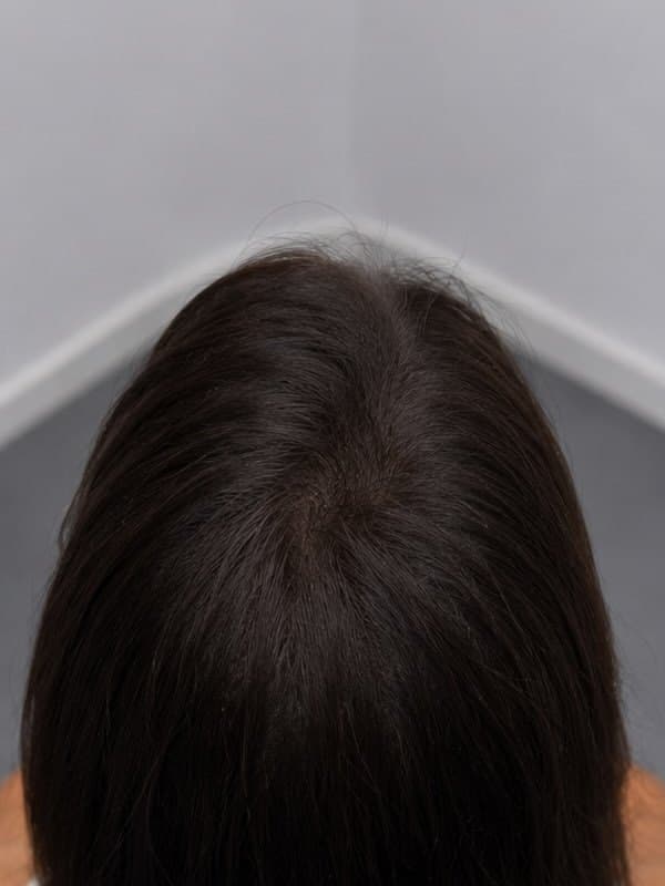 Tricopigmentation, raie clairsemée, femme, Après