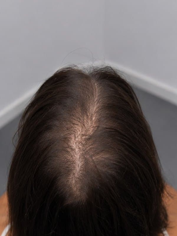 Tricopigmentation, raie clairsemée, femme, Avant